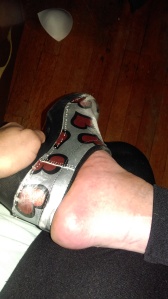 Image of right foot.  Trying to put on silver clogs, which are wore out and scratched from toe dragging while walking with crutches.